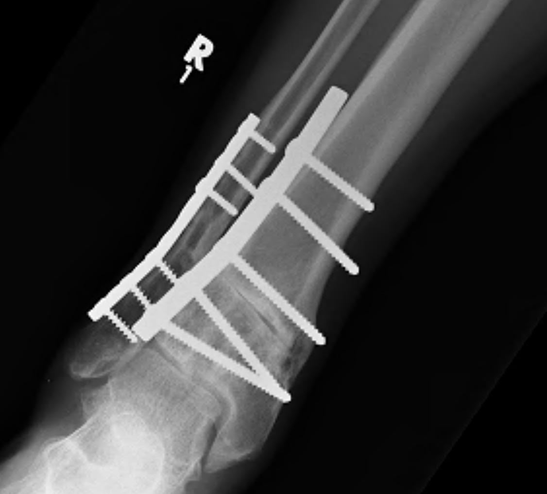 Distal Tibial Malunion Correction